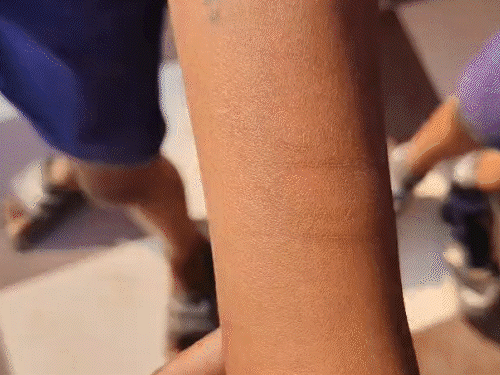 ब्लेड-पिन-कांटे से 35 स्कूली बच्चों ने हाथ काटे:खेल-खेल में एक दूसरे को टास्क दिया; प्रिंसिपल-हेडमास्टर को नोटिस; कौन सा गेम इसकी जांच होगी