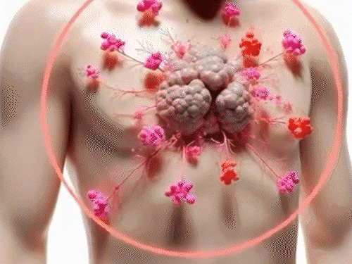 11 साल के मासूम को इनवेसिव थायमिक कैंसर:8 महीने में हो जाती मौत, मेकाहारा में सक्सेफुल सर्जरी; 10 करोड़ में एक को होता है