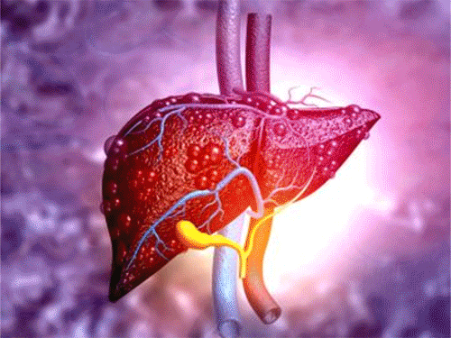 वर्ल्ड लिवर डे…गलत लाइफस्टाइल खराब कर सकती है लिवर:शराब ही कारण नहीं, डॉक्टर बोले- समोसा-पिज्जा फैटी लिवर के लिए जिम्मेदार, जानिए बचने के उपाय