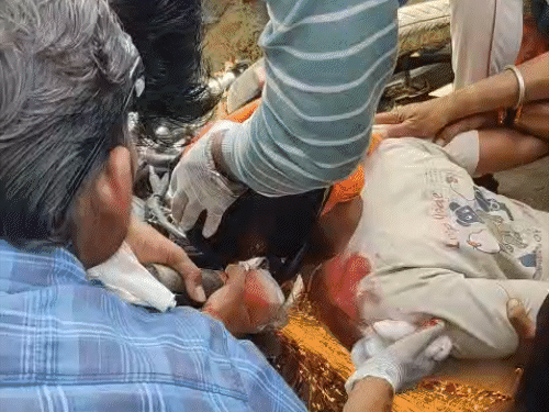 नपा कर्मचारी के सिर में घुसा बाइक का फुटरेस्ट,मौत, VIDEO:कटर से काटकर निकाला, बालोद में ओवरटेक के दौरान हुआ हादसा