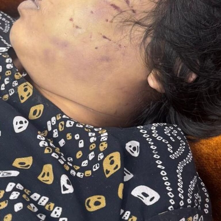 रायपुर में लिव-इन पार्टनर ने की गर्लफ्रेंड की हत्या:मारपीट के बाद गला दबाया, अस्पताल में शव छोड़कर भागा; पुलिस ने आरोपी को किया गिरफ्तार